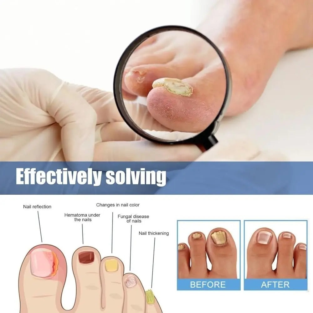 FungalPatch™ – Antibakterieller, schimmelhemmender Patch für effektive Nagelpflege [50% Rabatt]