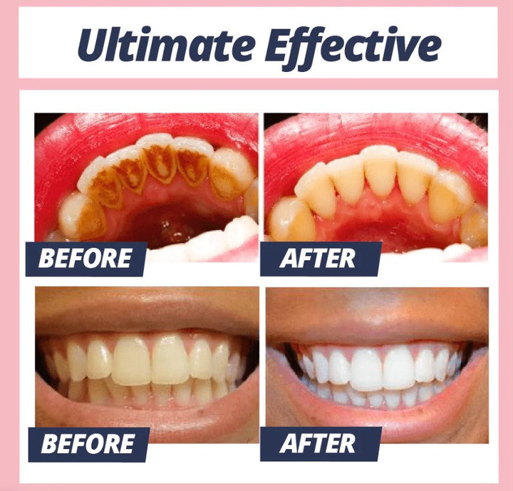 1 + 1 GRATIS HEUTE | CleanStain™- Jeden Tag ein schönes Lächeln haben!