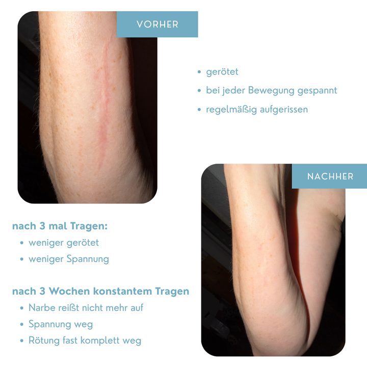 NarbenSanft™ Silikon-Narbenpflaster