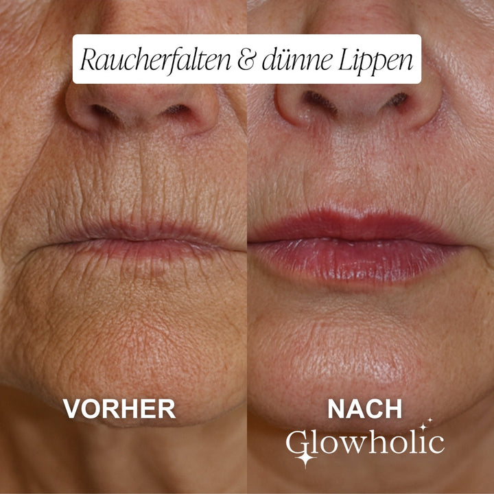 Anti-Falten Starter Set - Glowholic Micro-Needling Infusion für zuhause