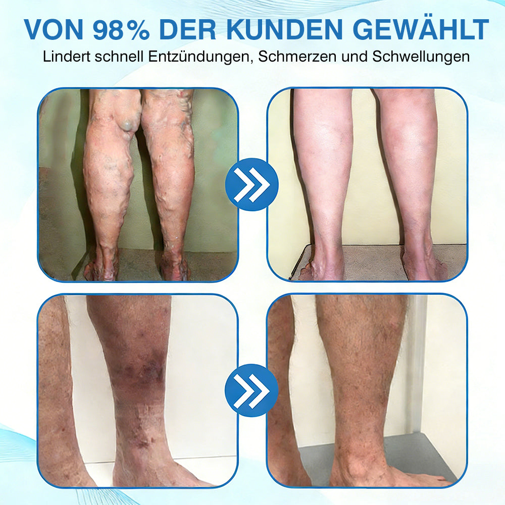 🇩🇪🏃‍🌿GFOUK® VascuCare Vein Healing Spray(Entwickelt für Krampfadern, Besenreiser, tiefe Venenthrombose (TVT), chronische venöse Insuffizienz, venöse Geschwüre, Thrombophlebitis und andere venöse Beschwerden)