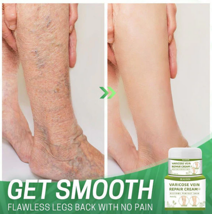 Varicose Repair Cream™ - Fühlen Sie sich wieder sicher