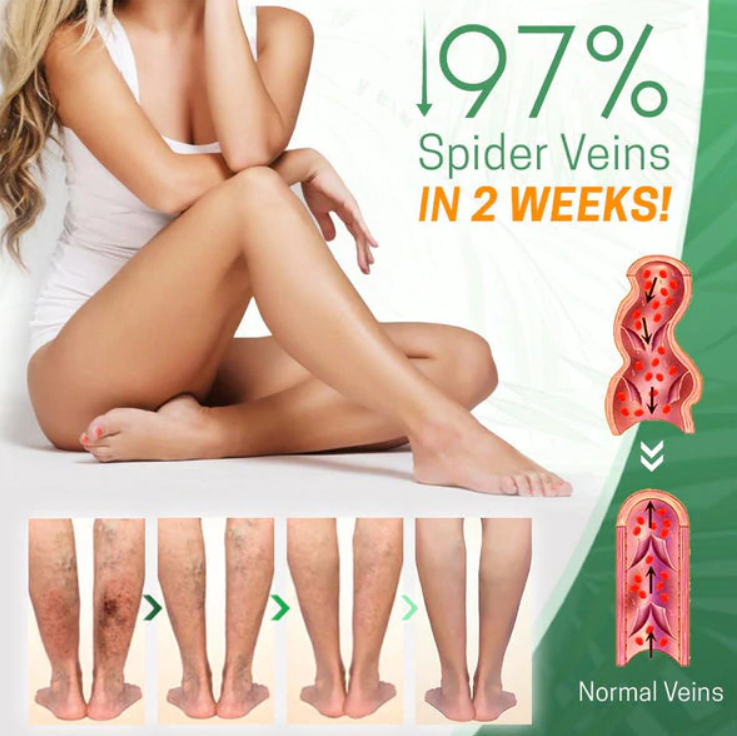 Varicose Repair Cream™ - Fühlen Sie sich wieder sicher