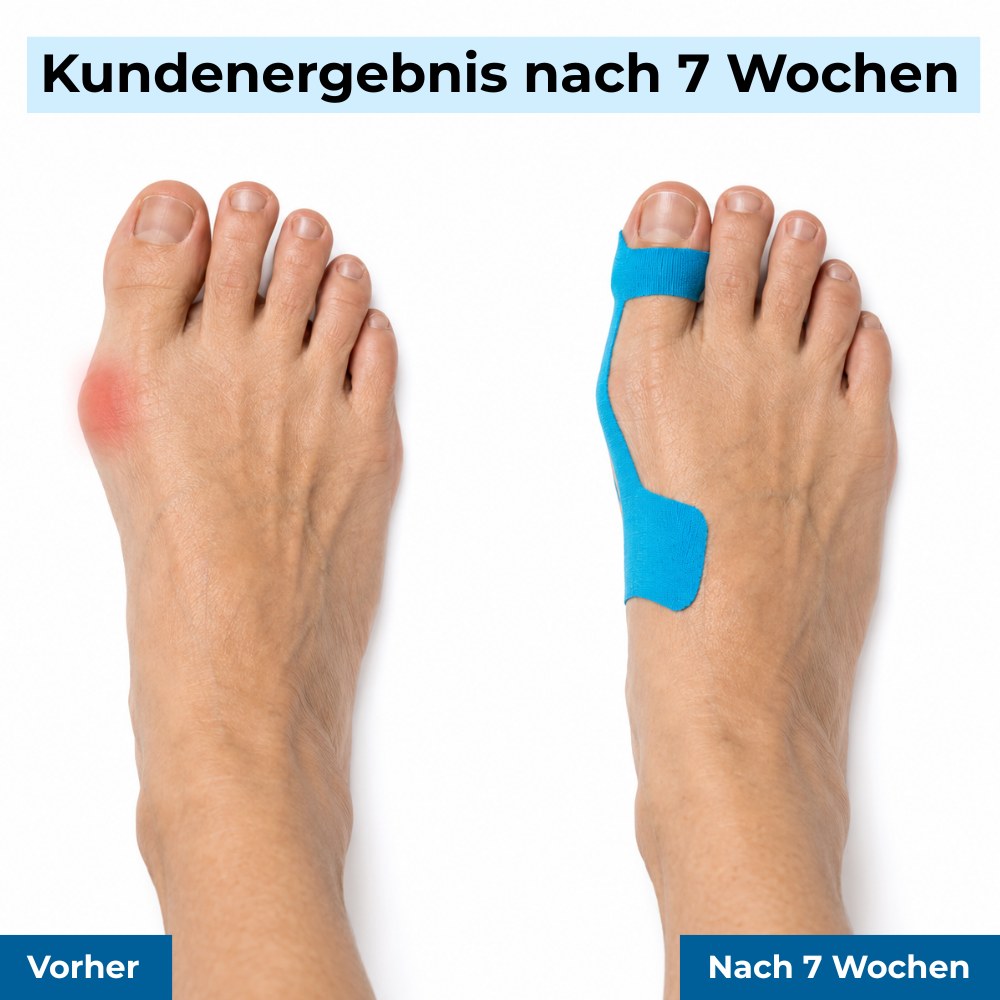 ZehenSanft™ Hallux-Valgus-Korrekturbandage