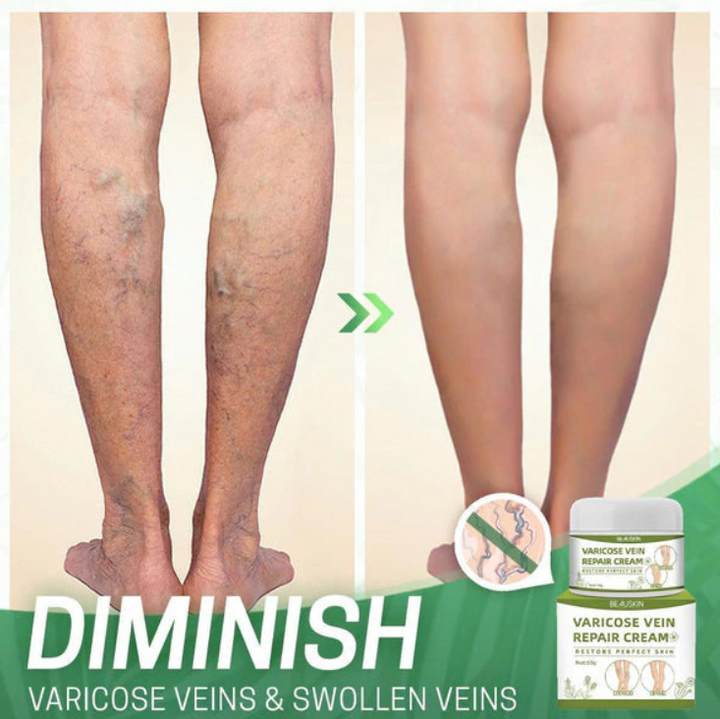 Varicose Repair Cream™ - Fühlen Sie sich wieder sicher