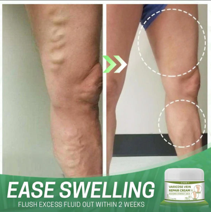 Varicose Repair Cream™ - Fühlen Sie sich wieder sicher