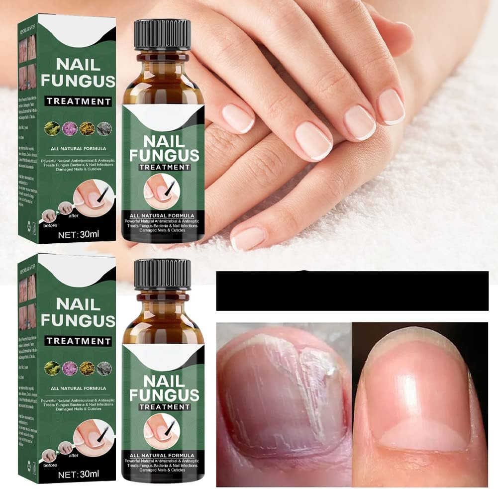 PureNail™ – Nagelpilz-Reparaturserum, heilt, restauriert & schützt beschädigte Nägel effektiv [1 + 1 Gratis]