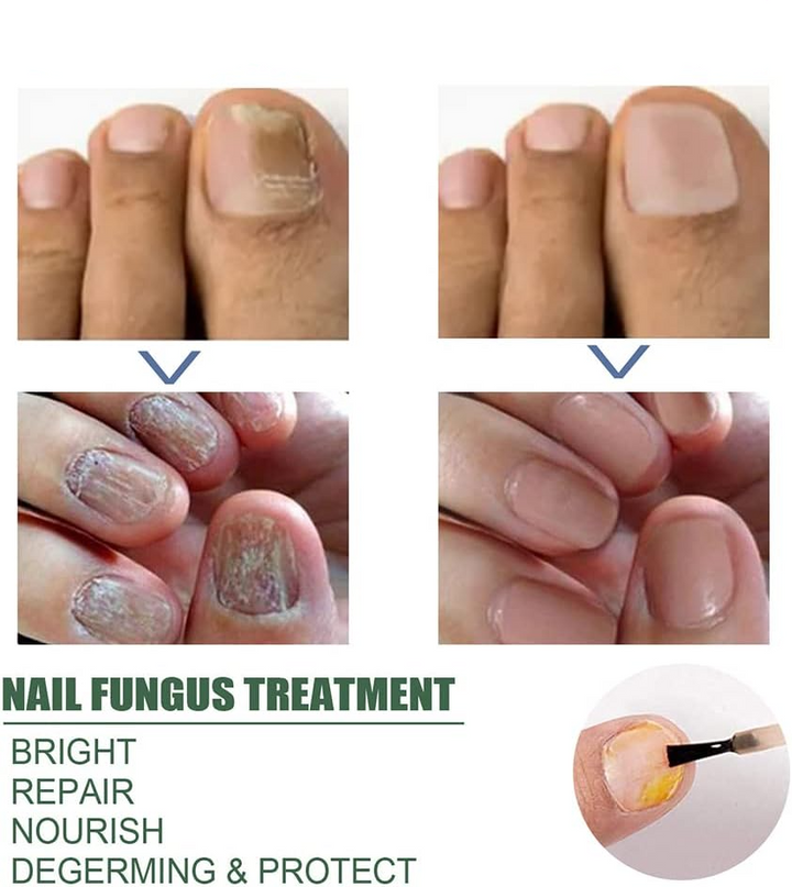 PureNail™ – Nagelpilz-Reparaturserum, heilt, restauriert & schützt beschädigte Nägel effektiv [1 + 1 Gratis]