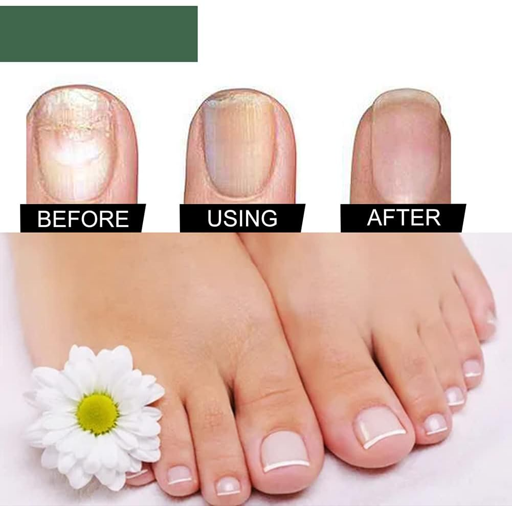 PureNail™ – Nagelpilz-Reparaturserum, heilt, restauriert & schützt beschädigte Nägel effektiv [50% Rabatt]