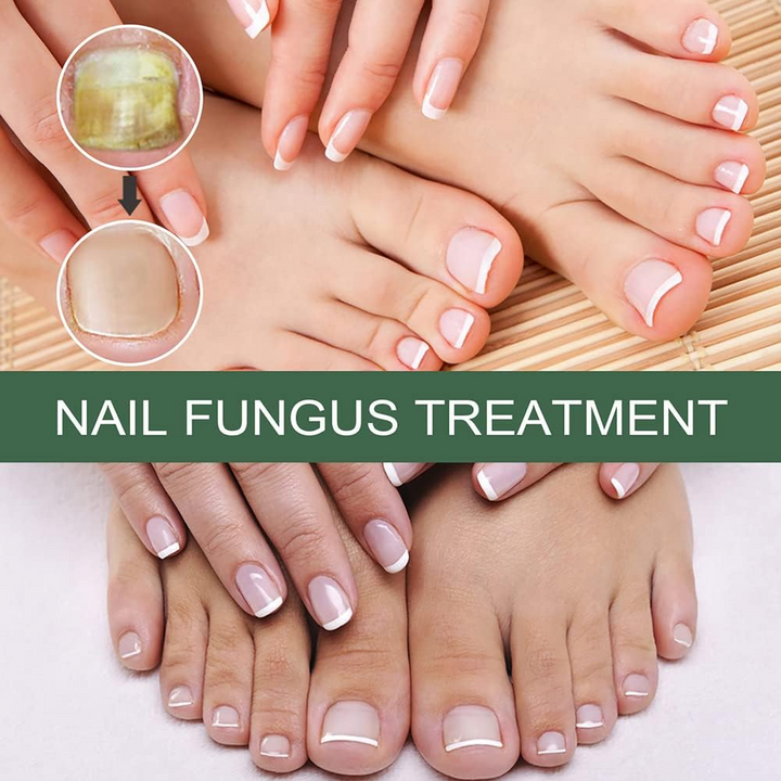 PureNail™ – Nagelpilz-Reparaturserum, heilt, restauriert & schützt beschädigte Nägel effektiv [1 + 1 Gratis]