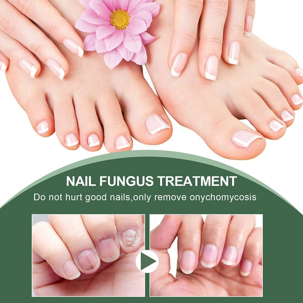 PureNail™ – Nagelpilz-Reparaturserum, heilt, restauriert & schützt beschädigte Nägel effektiv [50% Rabatt]