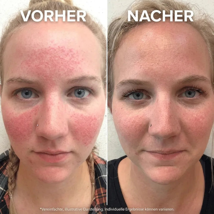 RötungsSanft™ Beruhigende Gesichtspflege gegen Rötungen