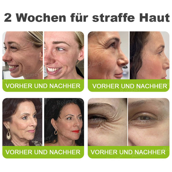 💫👨‍⚕️Jetzt jugendliche Haut zurückgewinnen 💫Rolimey® Botox & Vita-A Retinol Shot Falten-Lift Straffungscreme