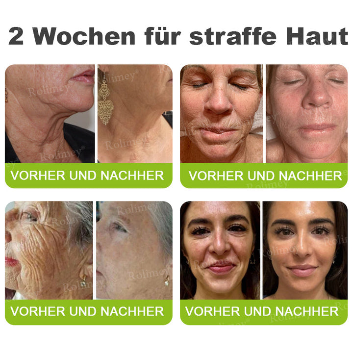 💫👨‍⚕️Jetzt jugendliche Haut zurückgewinnen 💫Rolimey® Botox & Vita-A Retinol Shot Falten-Lift Straffungscreme
