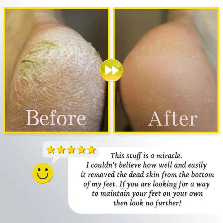 Gleam™ - Sanfte Hornhautentfernung für weiche, glatte Füße