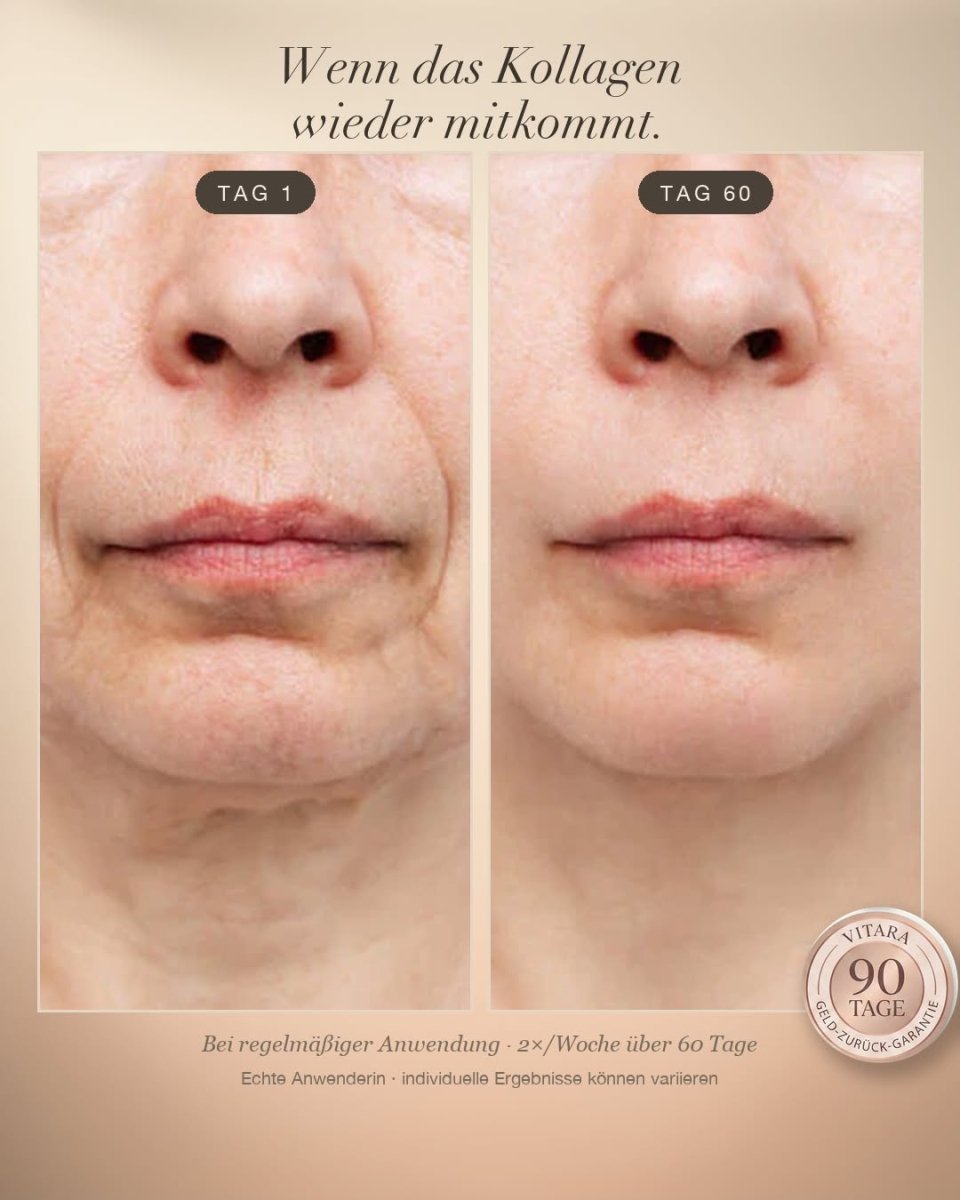 Anti-Falten-Starterset - VITARA Micro-Needling Infusion für zu Hause