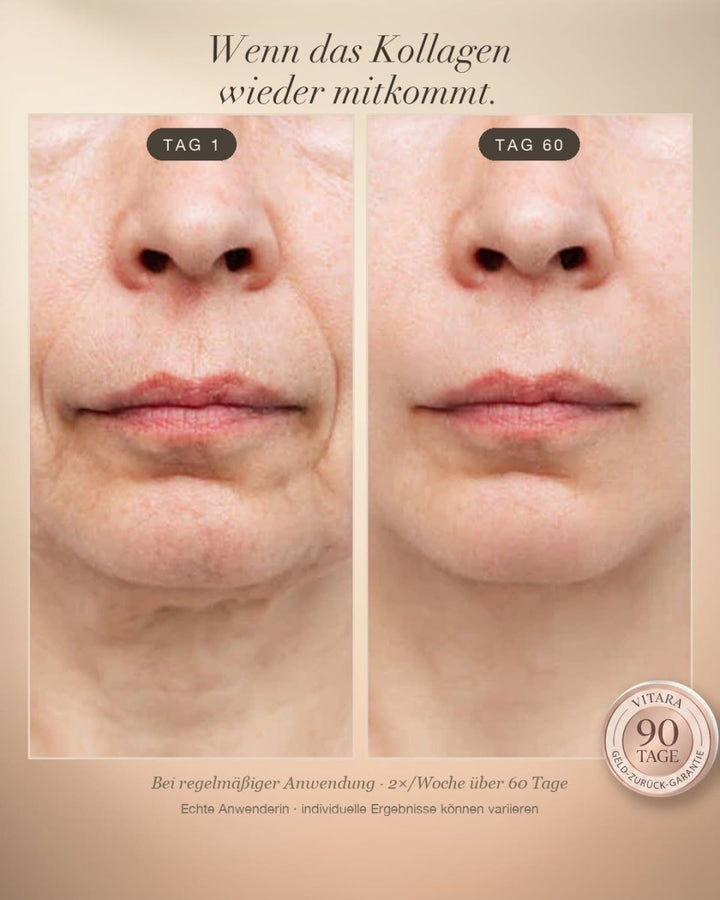 Anti-Falten-Starterset - VITARA Micro-Needling Infusion für zu Hause